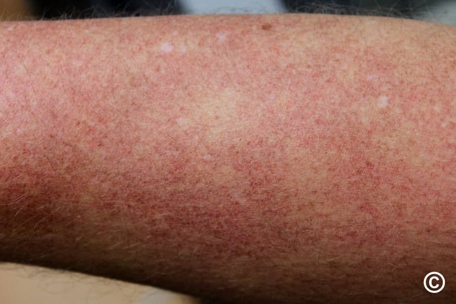 Smulkios raudonos dėmelės ir paraudimas ant galūnės odos, būdingi kapiliaritui ar kraujagyslių uždegimui.