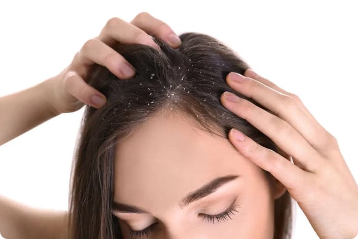 Moteris praskleidžia plaukus, atidengdama galvos odą su baltomis pleiskanomis – seborėjinio dermatito požymiai.