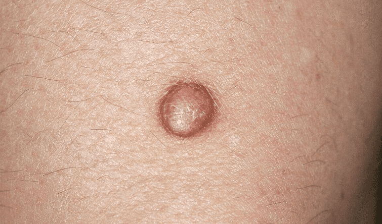 Mažas kupolo formos rusvas dermatofibromos darinys ant odos – nepiktybinis ir kietas mazgelis.