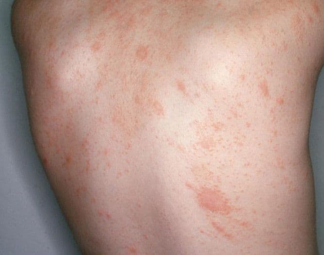 Rožinė dedervinė (Pityriasis rosea) – rausvų žvynuotų dėmių bėrimas ant nugaros ir šono.