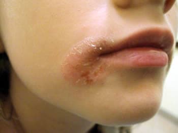 Paraudusi, sutrūkinėjusi ir pleiskanojanti oda lūpos kampe, būdinga anguliariniam cheilitui.