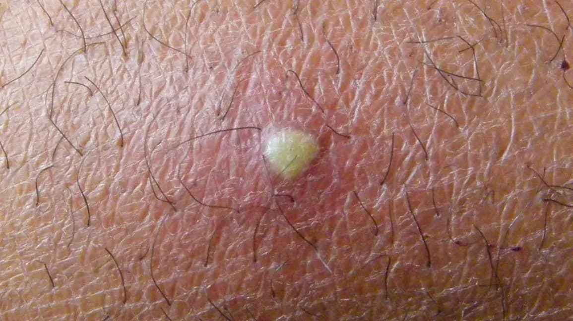Furunkulas su gelsva pūlinga galvute ir paraudusia oda plaukuotoje srityje – odos liga vertinama dermatologo.