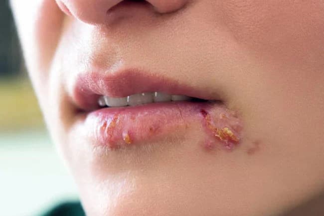Apatinė lūpa su pūslelinės žaizdelėmis ir geltonomis šašuojančiomis vietomis, būdingomis herpes simplex infekcijai.