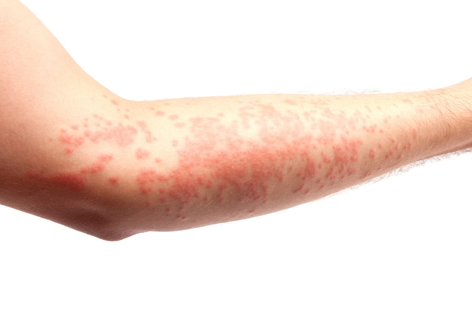 Paraudusi, smulkiomis pūslelėmis nusėta dilbio oda su kontaktinio dermatito požymiais ties alkūne.
