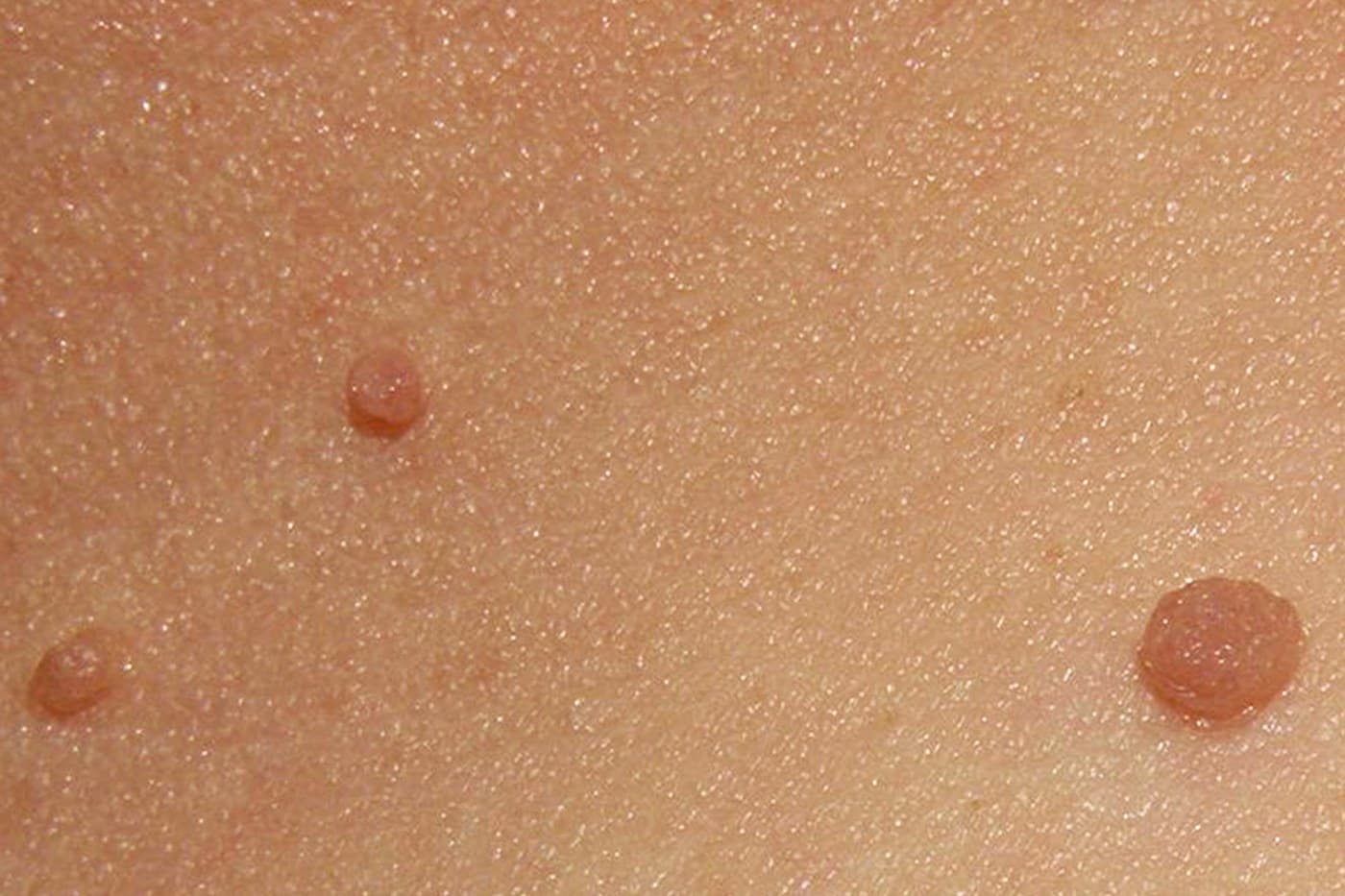 Minkštosios fibromos (skin tag) | Jmarchn, CC BY-SA 3.0, Wikimedia Commons Minkštosios fibromos (odos karpelės) ant kaklo odos